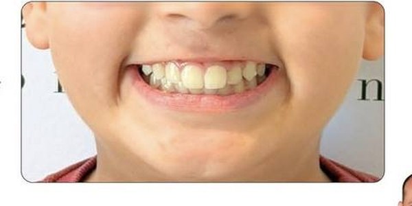 Avant traitement orthodontique enfant — Dr Amine Ben Ayed, Tunis