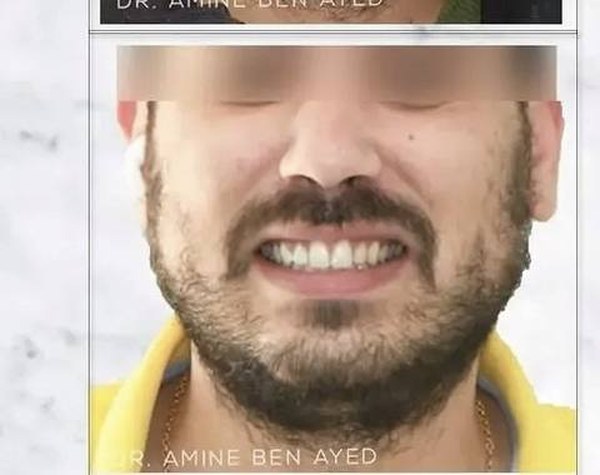 Avant correction d'alignement et d'occlusion adulte — Dr Amine Ben Ayed, Tunis