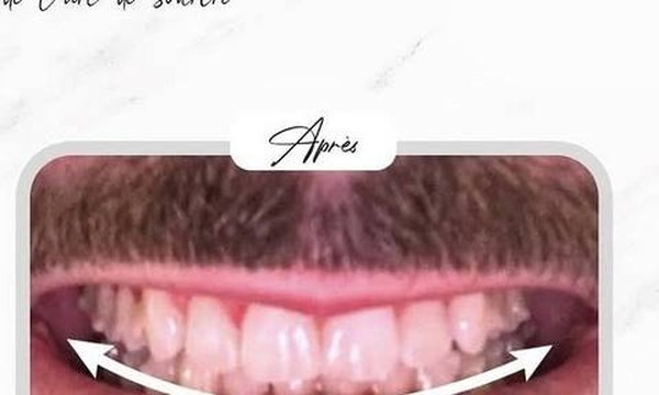 Avant perfectionnement Ideal Smile Arc — Dr Amine Ben Ayed, Tunis