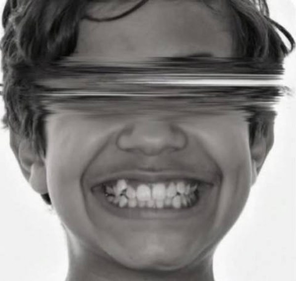 Après traitement orthodontique adolescent — Dr Amine Ben Ayed, Tunis